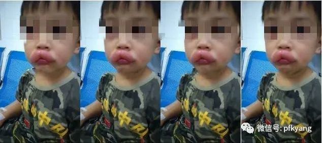 男孩吃葡萄過敏腫成嘟嘟嘴怎么回事？畫面詳情曝光網友忍不住笑了(圖2)